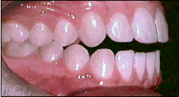 Anterior open bite example image.
